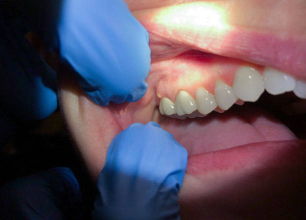 Best Emergency Wisdom Teeth Removal in Lost Hills, CA